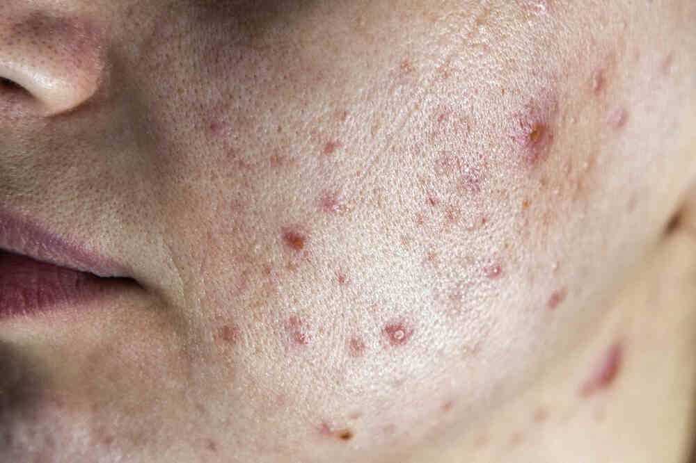 Female patient suffering from acne, view from front of her left cheek. Medazur Medical Clinic in Leytonstone.