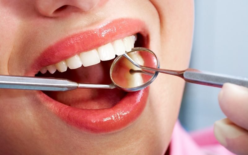 Female patient having dental clean-up done, mouth shot. Medazur Medical Clinic in Leytonstone.