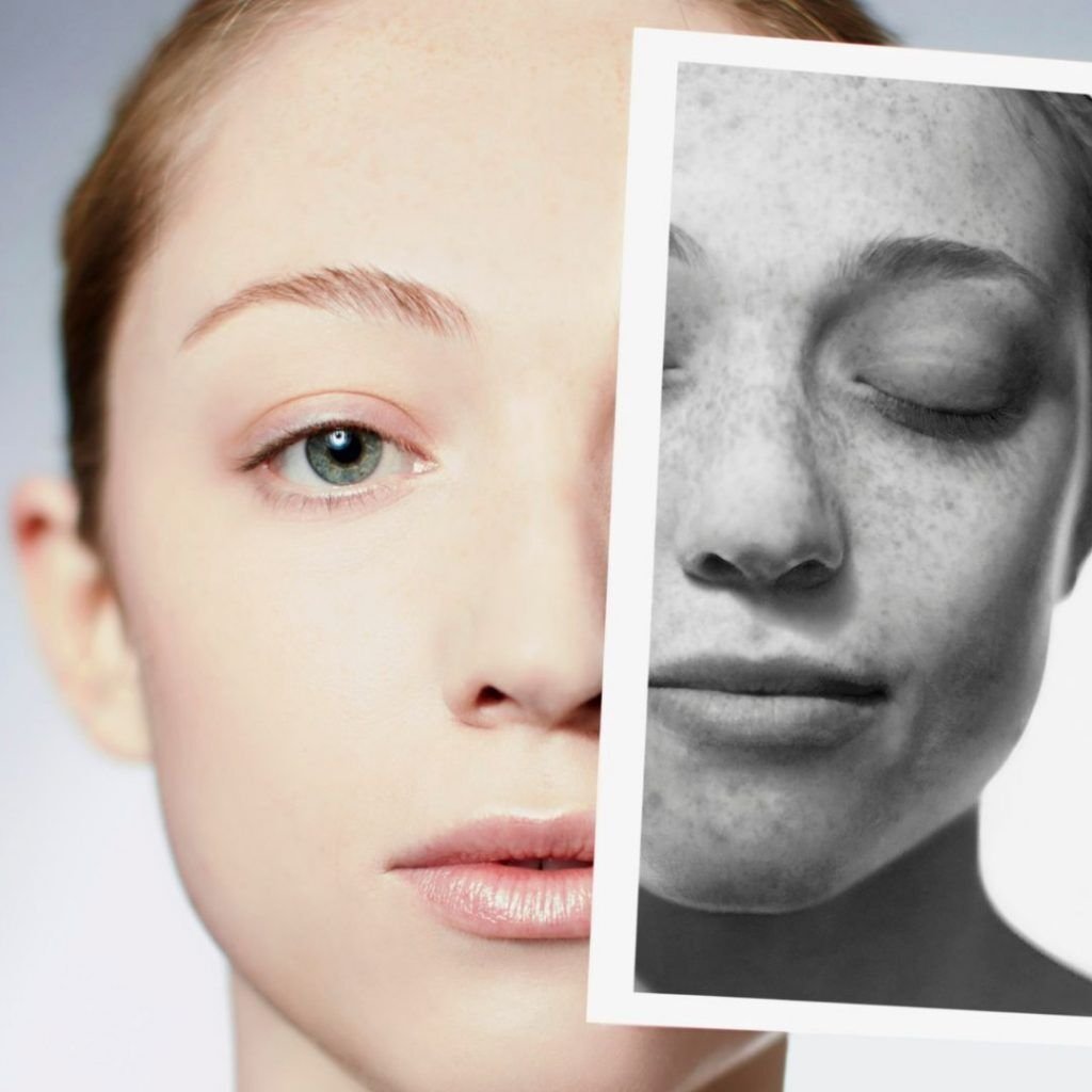 Lady skin condition before and after. Medazur Medical Clinic in Leytonstone.