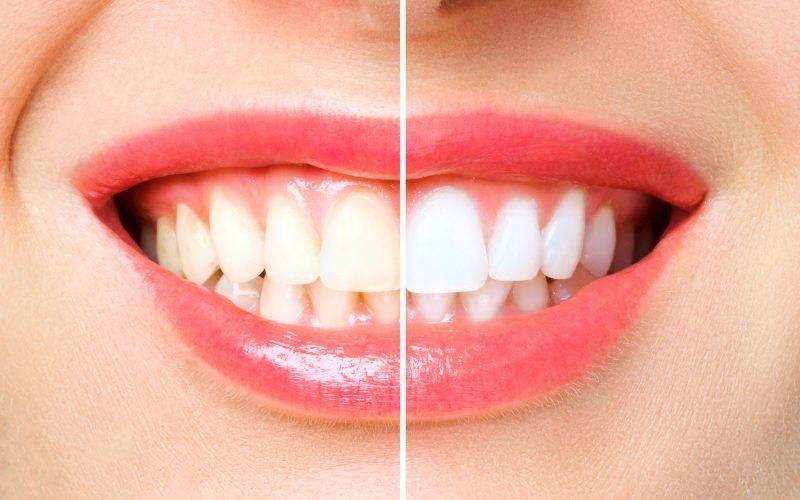 Teeth Whitening Before and After Treatment. Medazur Medical Clinic in Leytonstone.