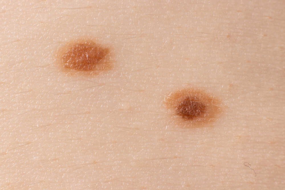 Skin with two moles on it. Medazur Medical Clinic in Leytonstone.